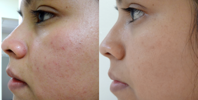 Higa_3-27-2014_Acne1_B-A