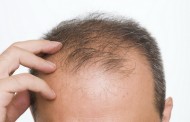 Rani gubitak kose, znak koji ne treba da ignorišete