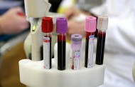 ZAPANJUJUĆI REZULTATI NAJNOVIJIH ISTRAŽIVANJA: Krv vegetarijanaca je 8 puta efikasnija u ubijanju ćelija raka